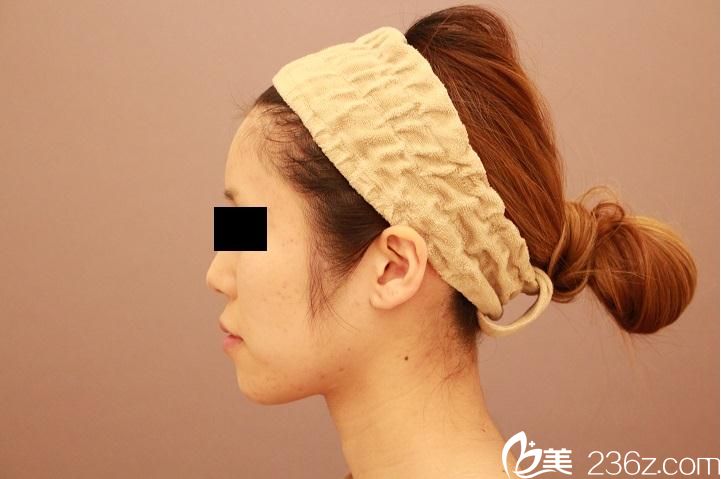 脸部脂肪填充后