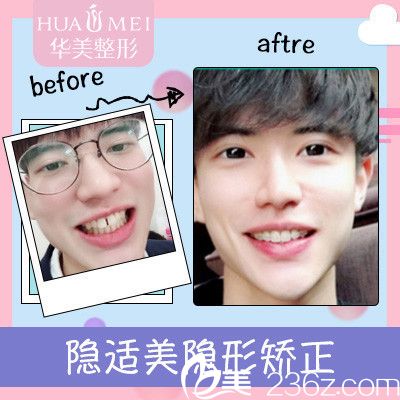 汕头华美王宏伟隐适美牙齿矫正案例
