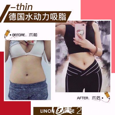 汕头华美杨善医生做的腰腹吸脂案例