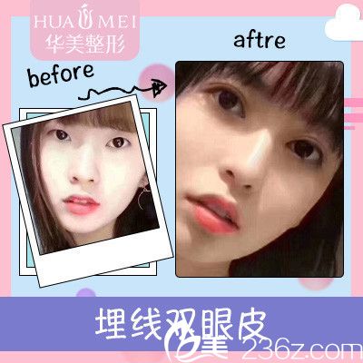 汕头华美蒋友宁院长做的双眼皮案例