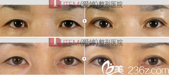 韩国ITEM（爱婷）整形医院眼部整形案例