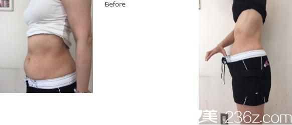 EXILIS机器进行脂肪吸引