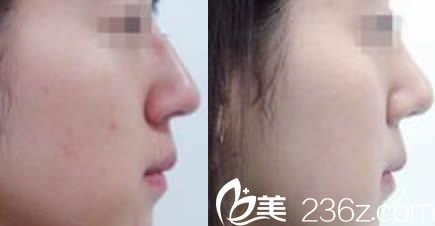 楚雄吴氏嘉美鼻综合整形案例前后对比图 楚雄吴氏嘉美鼻综合整形案例前后对比图