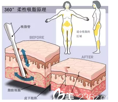 北京玲珑梵宫水动力吸脂特惠价格来袭！首部位666元，名医王光辉坐诊