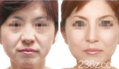 楚雄吴氏嘉美整形美肤除皱案例效果对比图 楚雄吴氏嘉美整形美肤除皱案例效果对比图