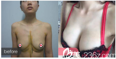 广州懿美秀整形医院隆胸案例对比图