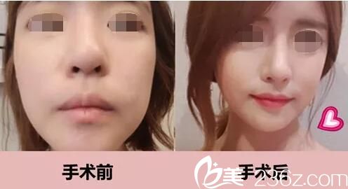 韩国ID鼻修复术前术后对比照