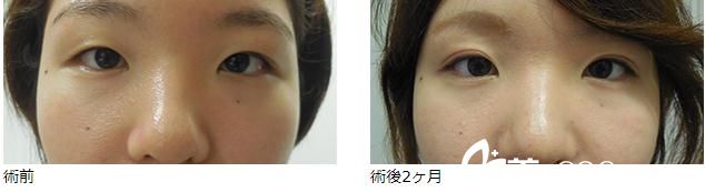 全切双眼皮 全切双眼皮