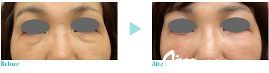 高浓度PRP治疗法:去除松弛皱纹 高浓度PRP治疗法:去除松弛皱纹