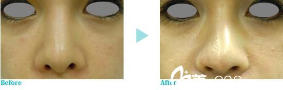 隆鼻手术 隆鼻手术