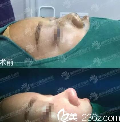 赣州华美整形医院鼻修复手术对比效果
