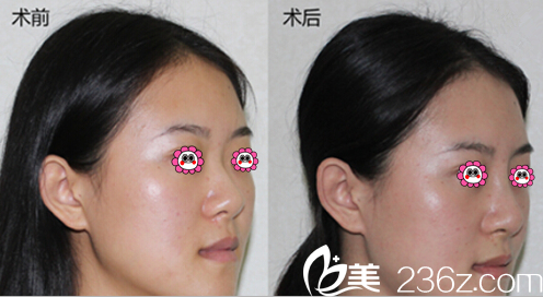 北京麦西美嘉朱冰医生自体耳软骨鼻综合隆鼻案例