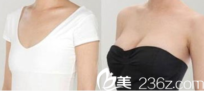 北京麦西美嘉徐永成医生假体隆胸案例 北京麦西美嘉徐永成医生假体隆胸案例