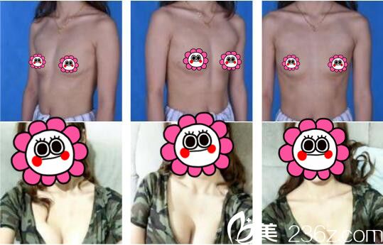 上海美莱自体脂肪隆胸真人案例