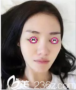 在北京麦西美嘉做隆鼻前样子 在北京麦西美嘉做隆鼻前样子