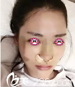 在北京麦西美嘉做硅胶假体隆鼻第3天效果 在北京麦西美嘉做硅胶假体隆鼻第3天效果