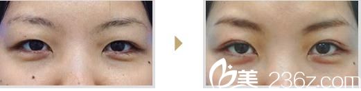 部分切开法 部分切开法