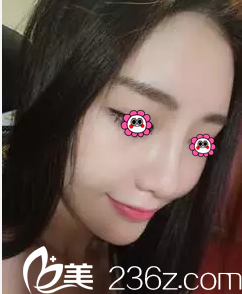 北京麦西美嘉硅胶假体隆鼻案例第56天效果 北京麦西美嘉硅胶假体隆鼻案例第56天效果