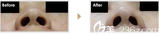 小鼻缩小法 小鼻缩小法