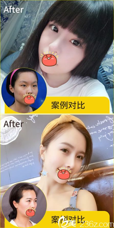 义乌阳光整形医院双眼皮隆鼻<span style= 义乌阳光整形医院双眼皮隆鼻<span style=