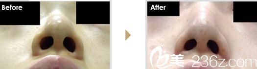小鼻縮小術（外側法）1.jpg 鼻翼缩小术