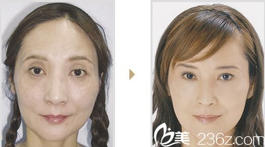 微整玻尿酸注射