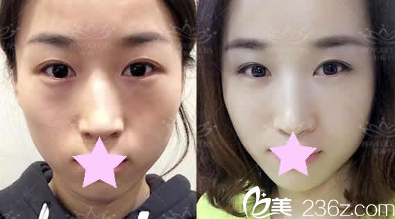 太原美媛荟整形自体脂肪全脸填充前后对比图 太原美媛荟整形自体脂肪全脸填充前后对比图