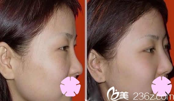 太原美媛荟整形鼻综合术前术后对比图 太原美媛荟整形鼻综合术前术后对比图