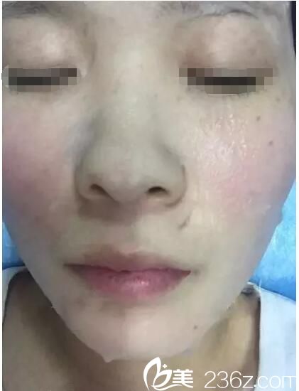 刚做完激光祛斑术后敷面膜 刚做完激光祛斑术后敷面膜