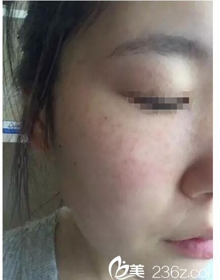 术后4天脸上开始结痂皮 术后4天脸上开始结痂皮