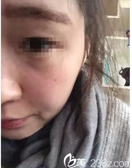 术后一周脸上斑点恢复 术后一周脸上斑点恢复