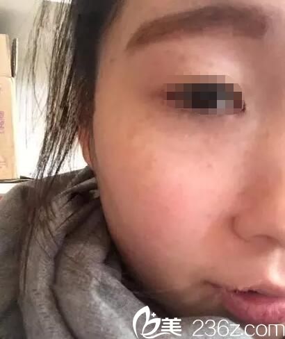 术后20天斑点淡化 术后20天斑点淡化