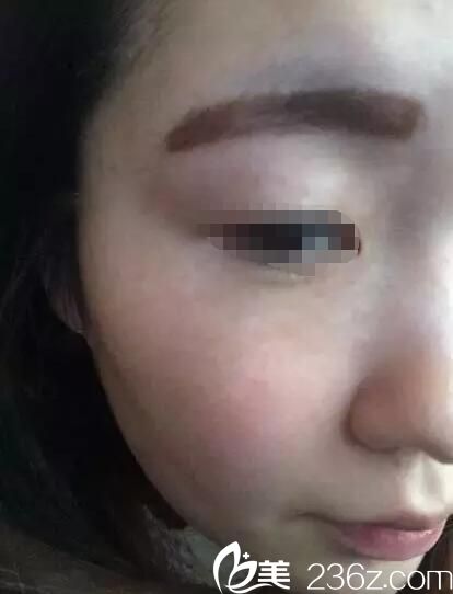 皮秒祛斑和大Q祛斑一样吗?看遗传麻子脸在泰州华美做大Q祛雀斑术后无后遗症效果还不错