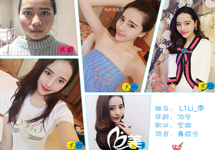 昆明伊美莱整形周诚医生隆鼻对比图 昆明伊美莱整形周诚医生隆鼻对比图