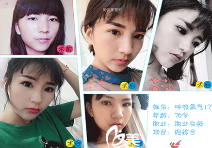 我在美伊莱整形双眼皮前后效果图 我在美伊莱整形双眼皮前后效果图