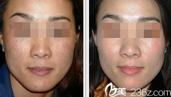 太原时光整形激光祛斑20天效果图 太原时光整形激光祛斑20天效果图