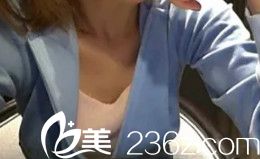 术前胸部平坦 术前胸部平坦