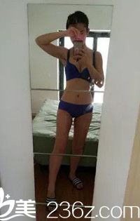 术后18天胸部变大腿部变细 术后18天胸部变大腿部变细