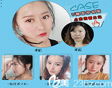 昆明美伊莱整形面部吸脂手术 昆明美伊莱整形面部吸脂手术