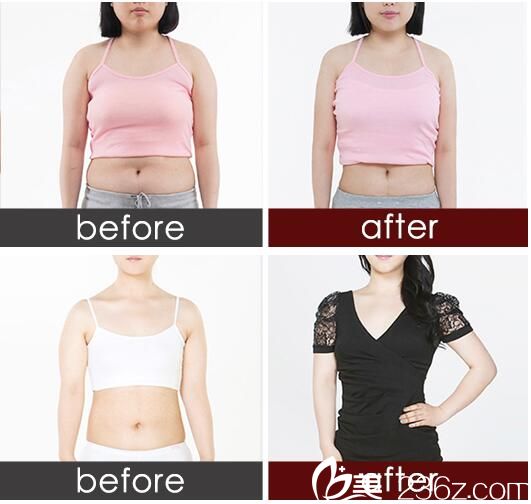 吸脂减肥对比<span style= 吸脂减肥对比<span style=