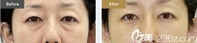 去除眼袋 去除眼袋