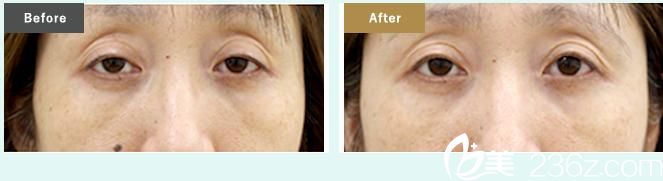 上眼部松弛 上眼部松弛