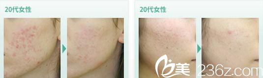 去除粉刺 去除粉刺