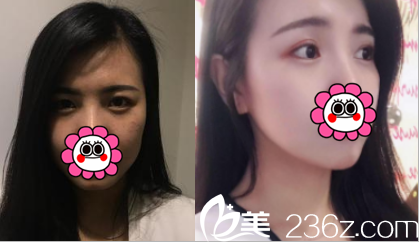 北京壹加壹切开双眼皮案例