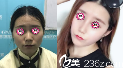 北京壹加壹耳软骨复合隆鼻案例