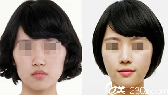 太原欧美莲整形全脸自体脂肪填充前后对比图 太原欧美莲整形全脸自体脂肪填充前后对比图