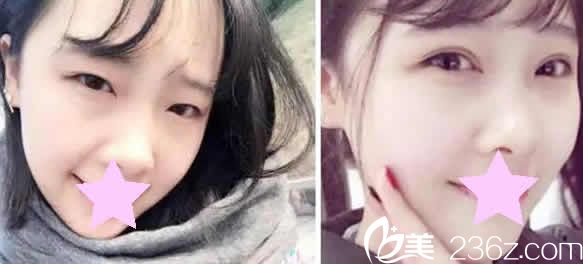 太原欧美莲整形姚冰双眼皮案例效果图 太原欧美莲整形姚冰双眼皮案例效果图