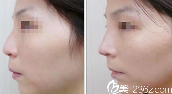 太原欧美莲整形张世民鼻综合案例图 太原欧美莲整形张世民鼻综合案例图