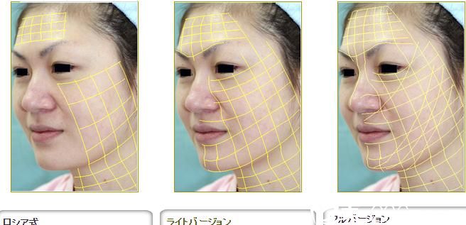 金线美容术 金线美容术