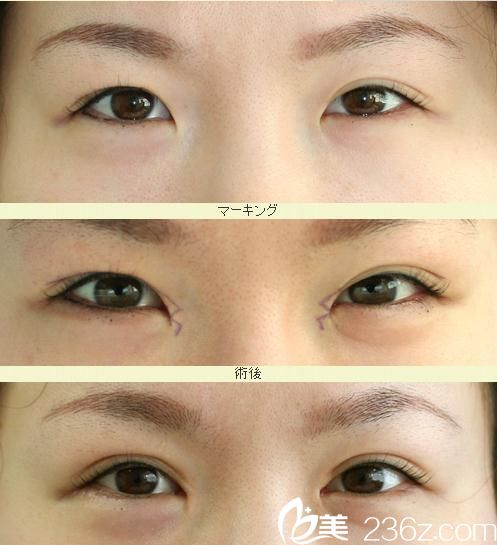 埋设法双眼皮 埋设法双眼皮